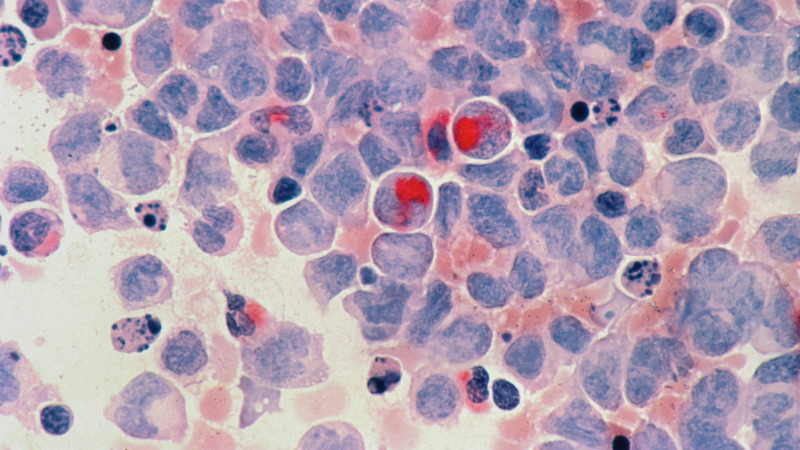 Sok életet menthet a mesterséges intelligencia: így gyorsítja a vérrák diagnosztikáját